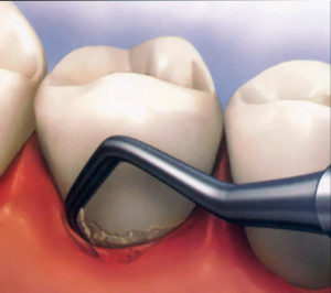 Curettage dentale 300x266