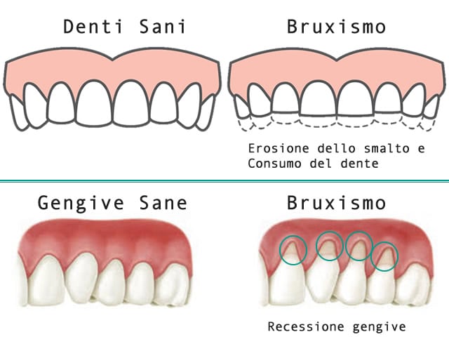bruxsismo